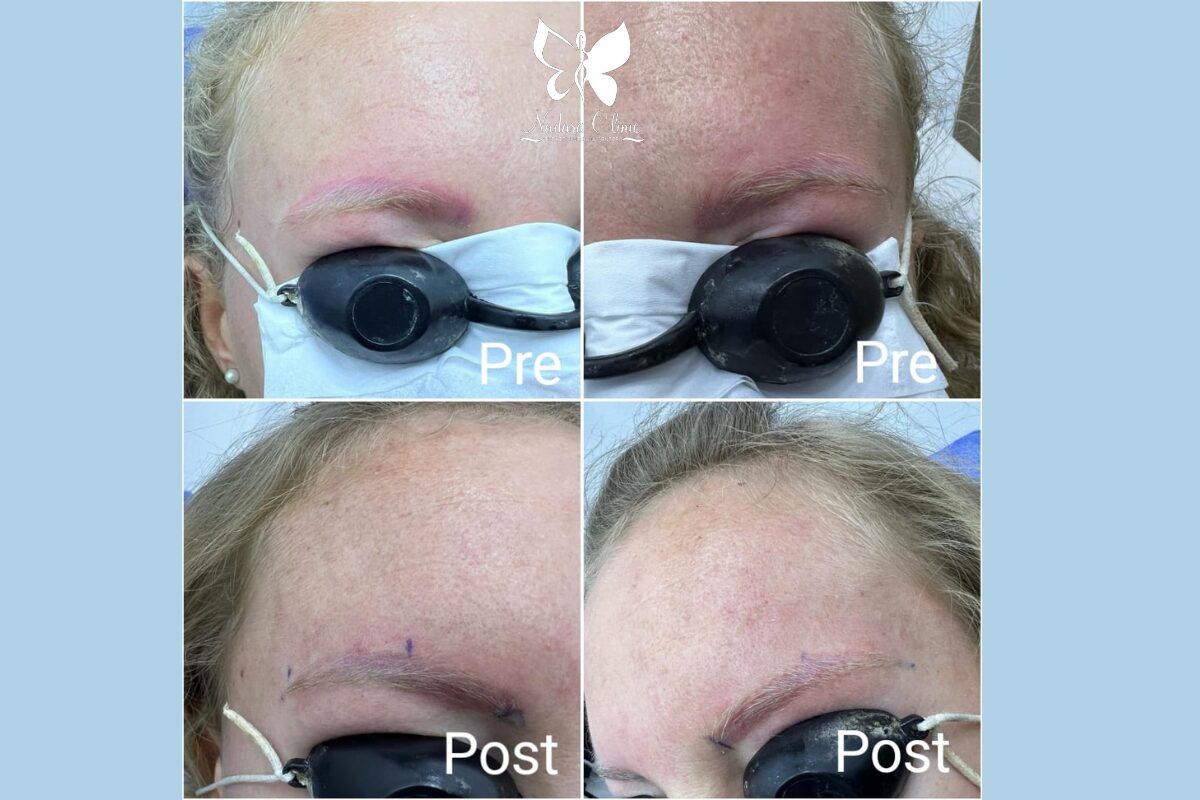 إزالة تاتو الحواجب في الغردقة